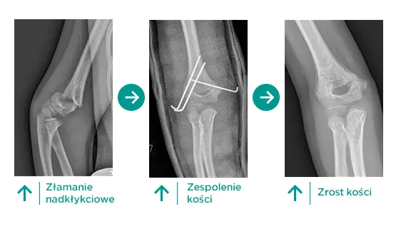 Złamania nadkłykciowe u dzieci
