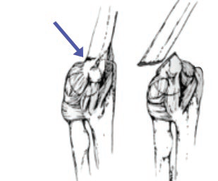 Złamania nadkłykciowe u dzieci