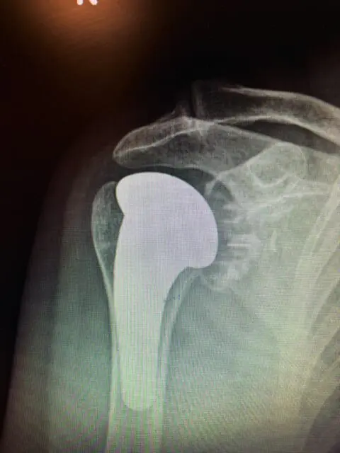 Proteza-stawu-ramiennego_zdjęcie-1_Carolina-Medical-Center-480x640 Choroba zwyrodnieniowa barku