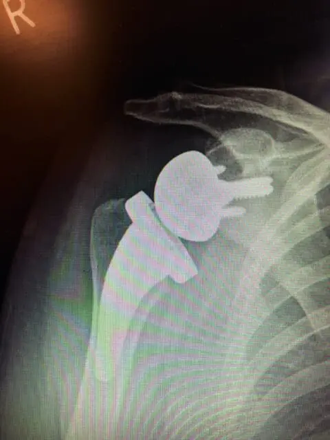 Proteza-stawu-ramiennego_zdjęcie-2_Carolina-Medical-Center-480x640 Choroba zwyrodnieniowa barku