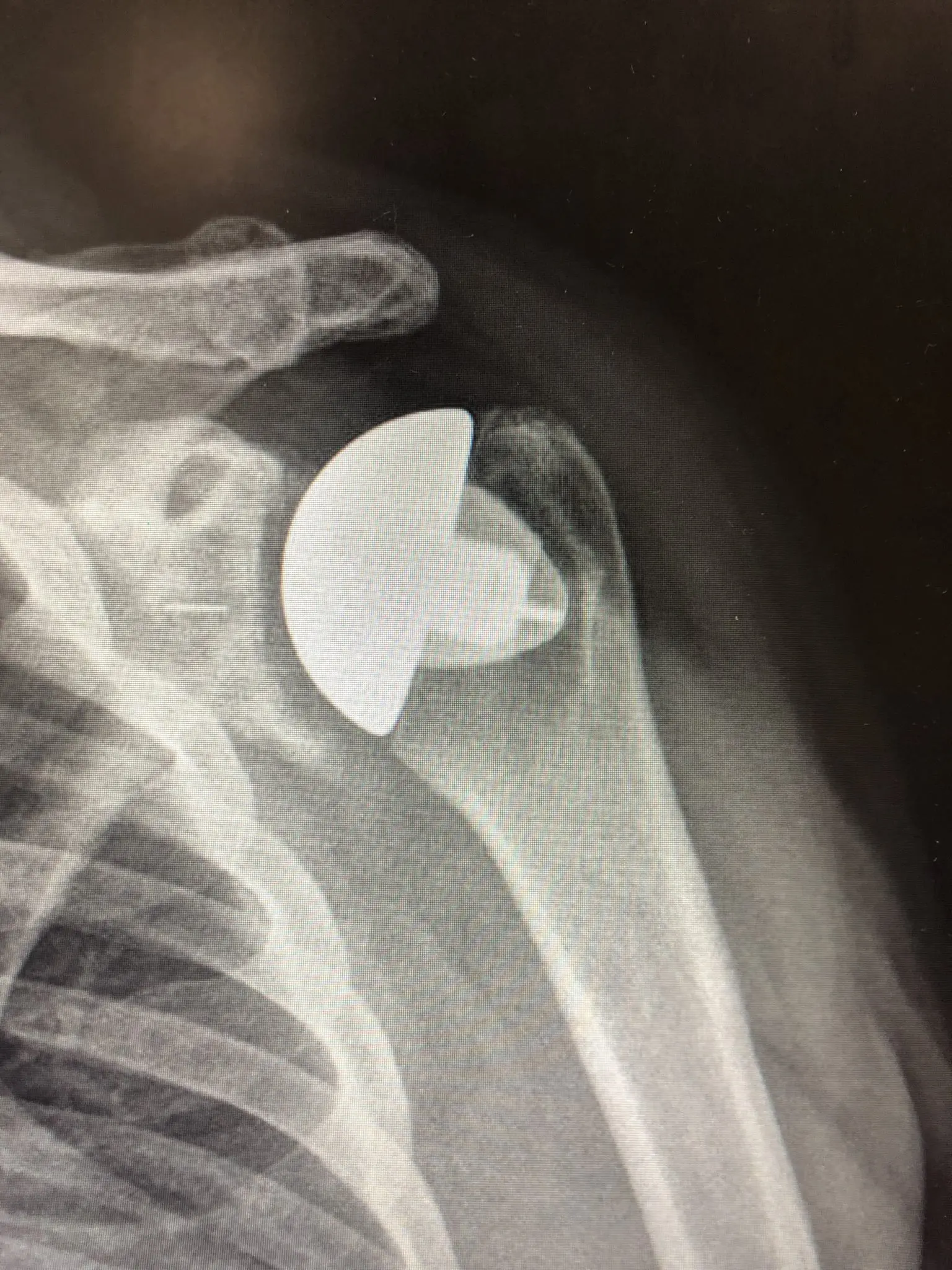 Shoulder replacement: standard in Europe, still rare in Poland