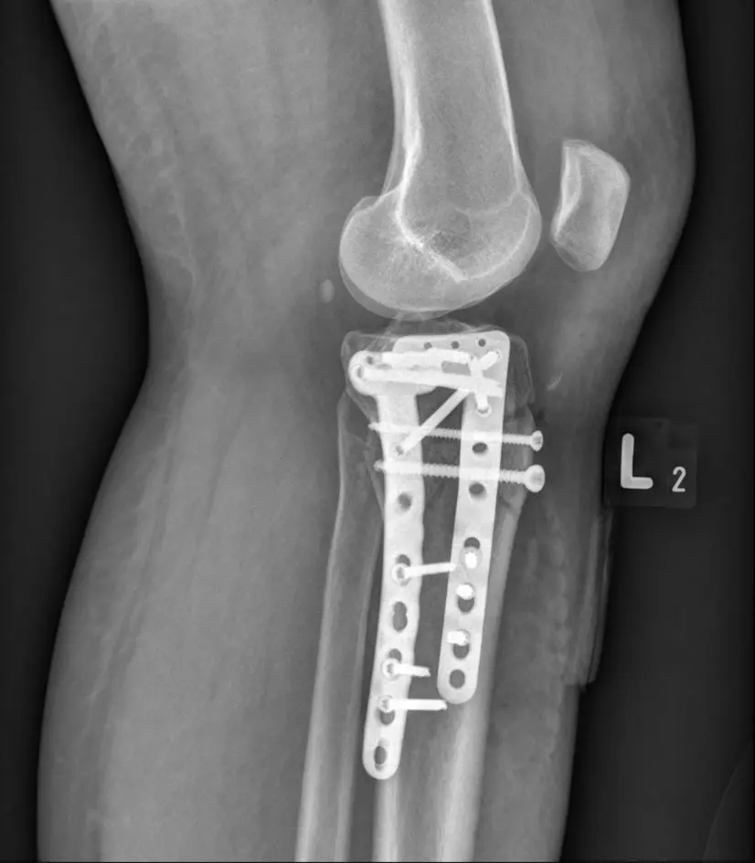 X-RAY: Stabilization of the proximal end of the tibia fracture after an accident