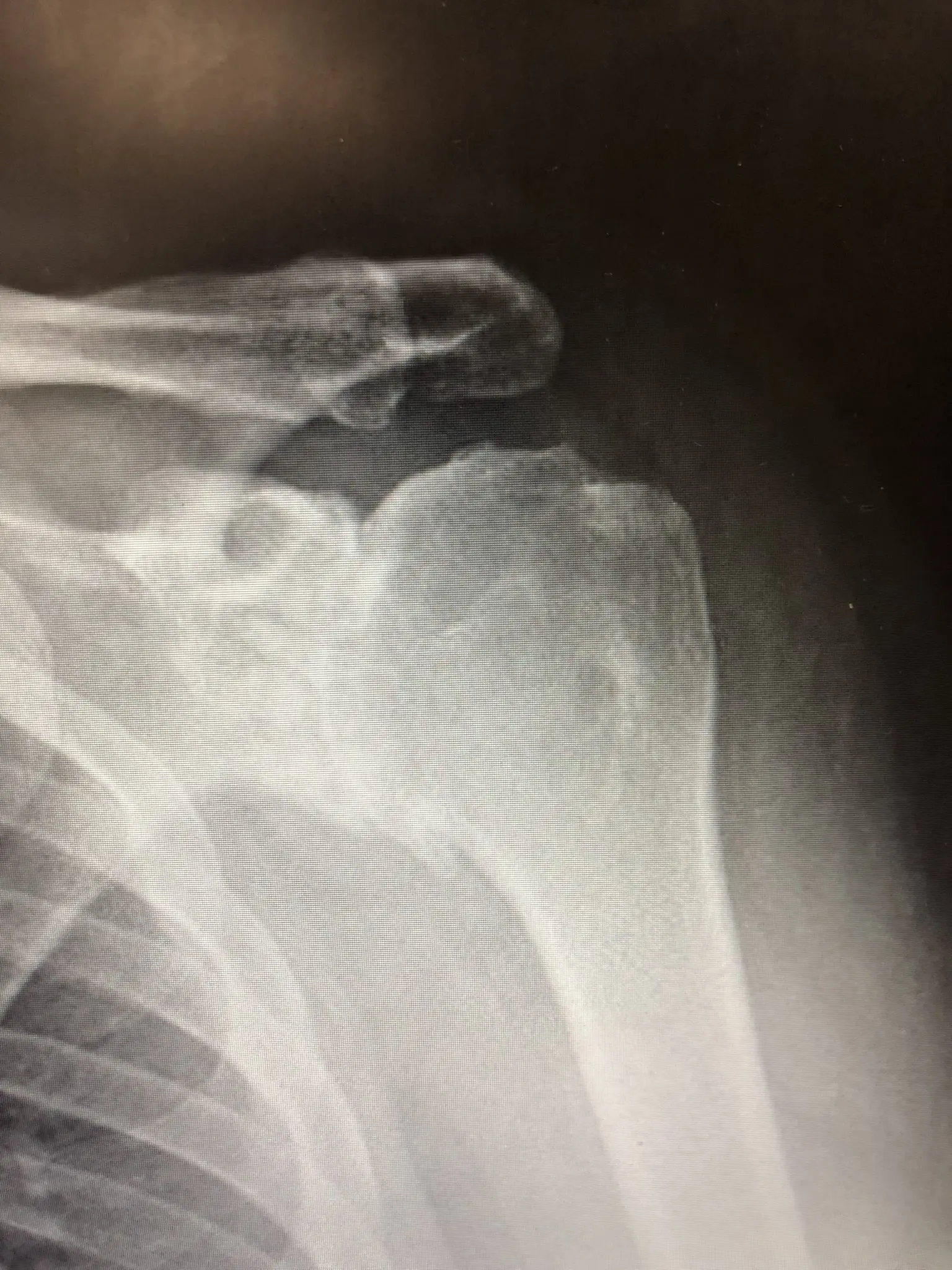 Shoulder replacement: standard in Europe, still rare in Poland