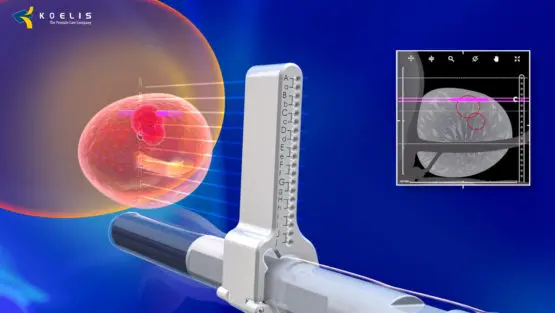 Prostate fusion biopsy is the most modern diagnostic test for prostate.