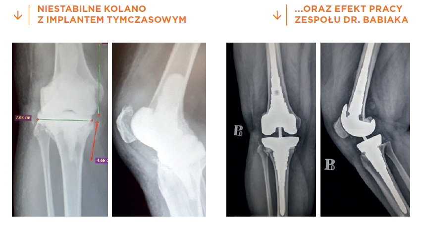 Wszczepienie Innowacyjnej Rewizyjnej Endoprotezy Stawu Kolanowego Carolina Medical Center 1