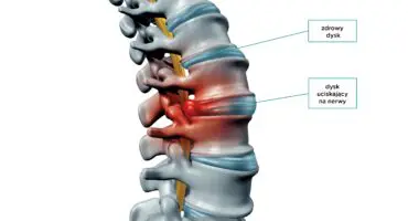 Techniki małoinwazyjne w leczeniu kręgosłupa w pigułce