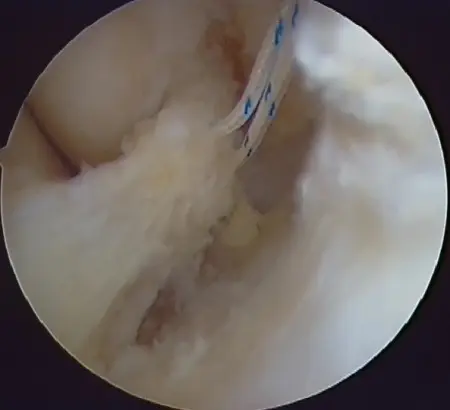 Description: Arthroscopy can reconstruct damaged ligament as well as replant detached part of a ...