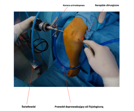 Zabieg artroskopii łokcia