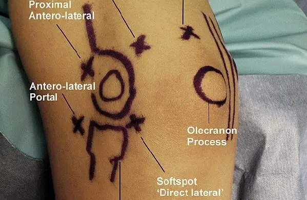 Cięcia skórne wykonujemy tak, aby ominąć nerwy, których uszkodzenie ma poważne konsekwencje.