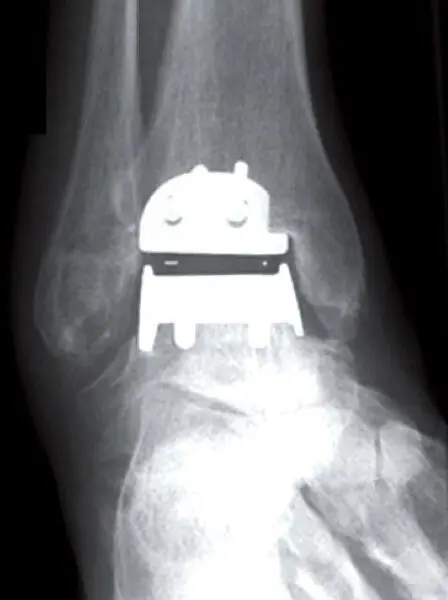 Proteza typu Hintegra stawu skokowego – widok od przodu