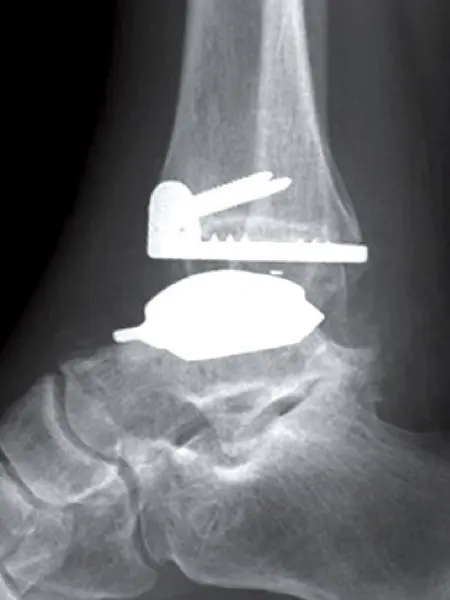 Proteza typu Hintegra stawu skokowego – widok z boku