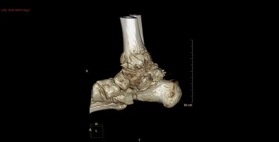 Rekonstrukcja 3D w tomografii komputerowej artrotycznego stawu skokowego