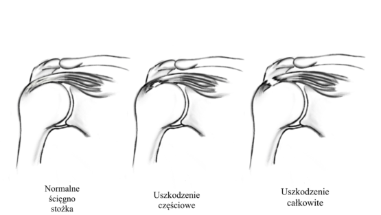 In English, from the left: Unbroken rotator cuff; Partial-thickness tear; Full-thickness tear