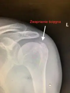 Zdjęcie RTG barku ze zwapnieniem ścięgna mięśnia nadgrzebieniowego