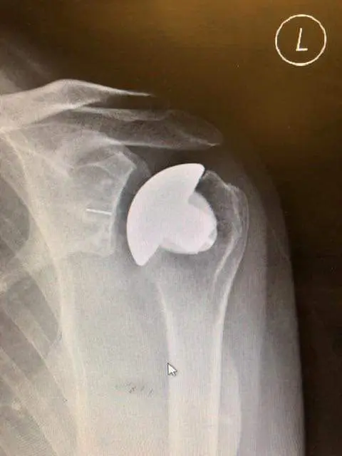 Zdjęcie RTG endoprotezoplastyki anatomicznej barku