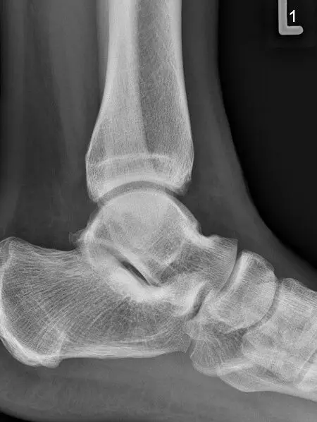 Zdjęcie RTG prawidłowego stawu skokowego – widok z boku