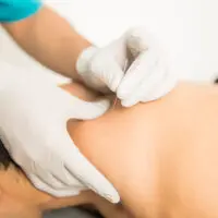 Dry needling in physiotherapy