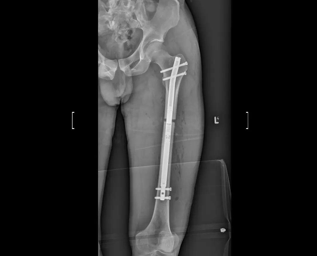 X-ray of the femur of a patient after limb lengthening surgery.
 