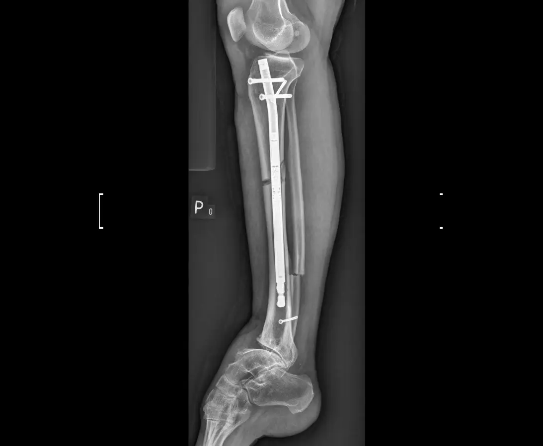 X-ray of the tibia of a patient after limb lengthening surgery.