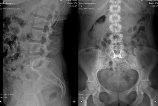 Stabilizacja kręgosłupa – ALIF, OLIF, XLIF, TLIF, PLIF