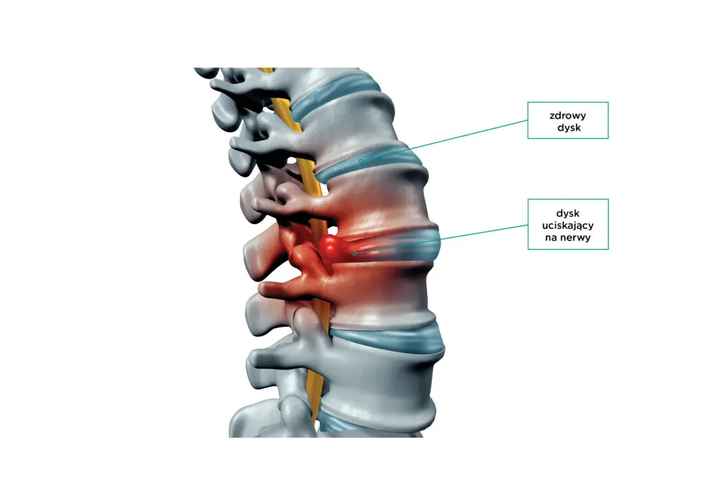 rysunek-1 Dyskopatia