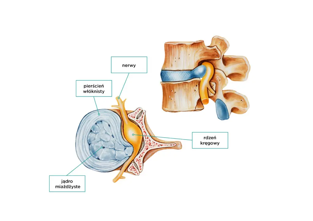 rysunek-2 Dyskopatia