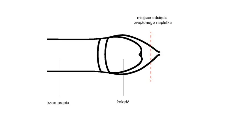 Plastyka napletka polega na odcięciu zwężonej części napletka i ponownym zeszyciu obu jego b...