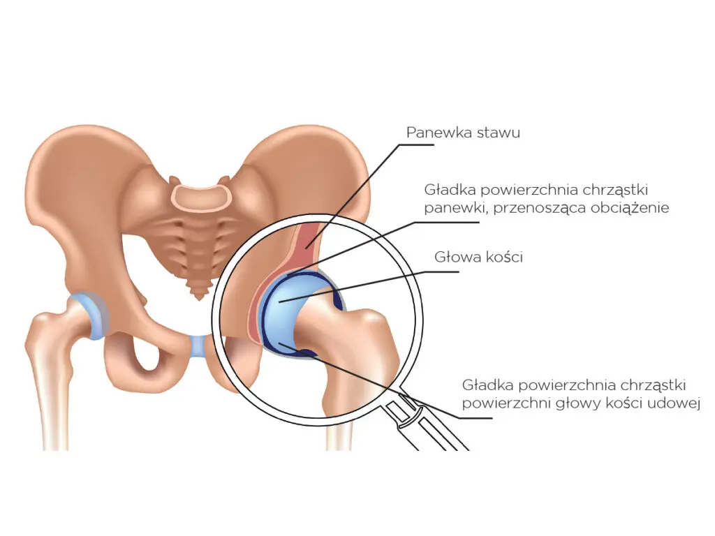 Endoprotezoplastyka biodra – czym jest?