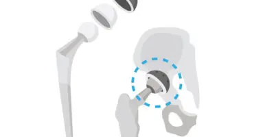 Implant dual mobility