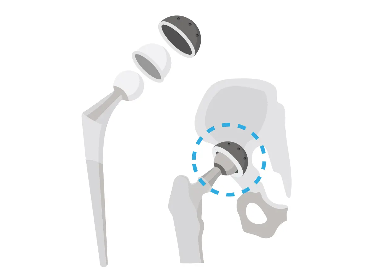 Poradnik dla Pacjentów: Endoprotezoplastyka biodra implant dual mobility