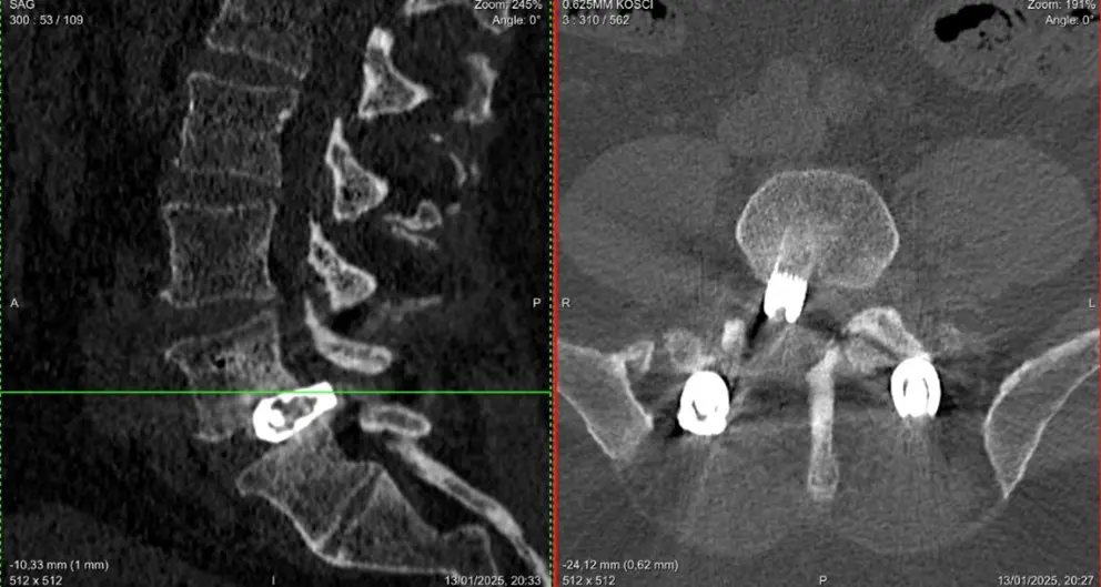 Z serii klinika do zadań specjalnych: Trzyetapowa operacja rewizyjna kręgosłupa L5-S1