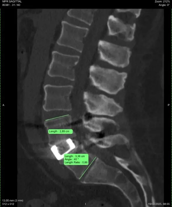 Z serii klinika do zadań specjalnych: Trzyetapowa operacja rewizyjna kręgosłupa L5-S1