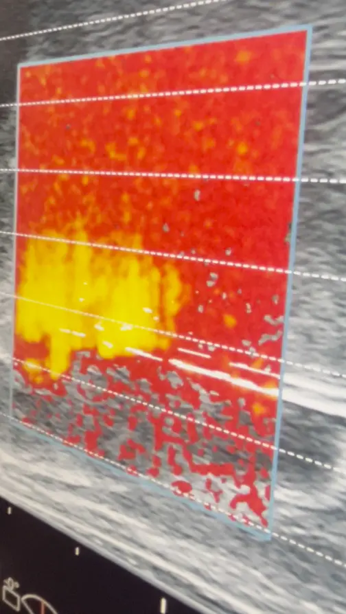 Oddziaływanie TMA na tkanki pod nadzorem USG Doppler