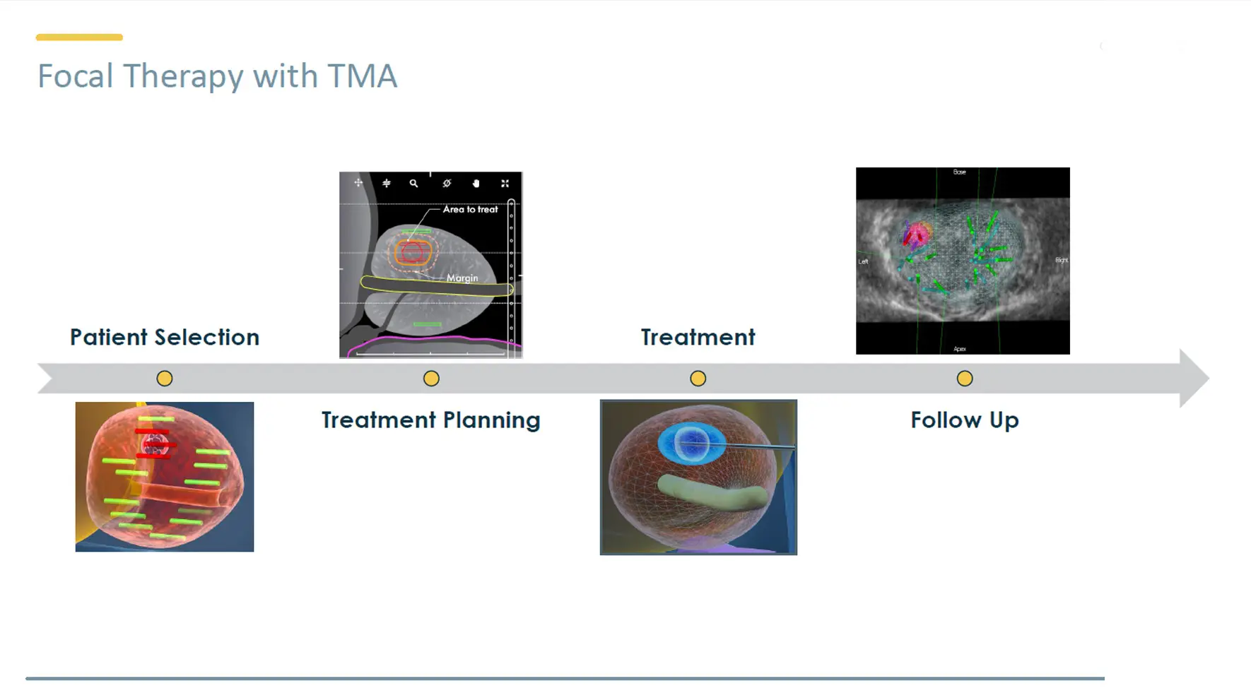 Proces diagnostyczny – biopsja fuzyjna, planowanie leczenia, terapia TMA, kontrola pozabiegowa