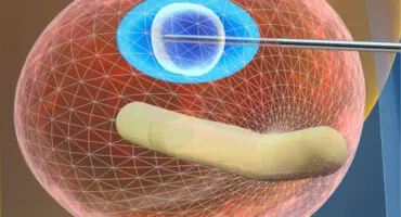 Celowana Terapia Mikrofalowa Raka Prostaty (TMA)