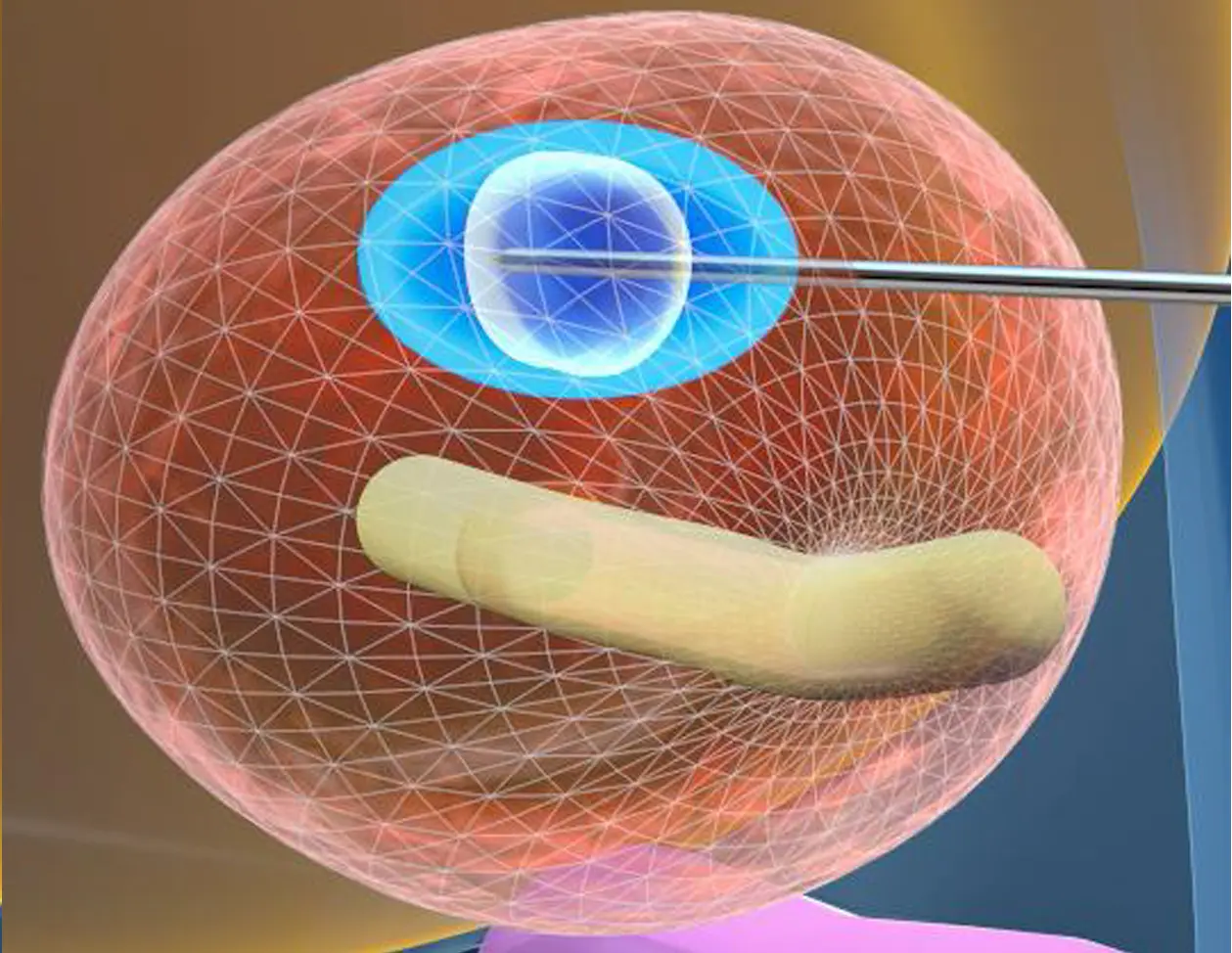Rekonstrukcja cewki moczowej w planowaniu leczenia TMA