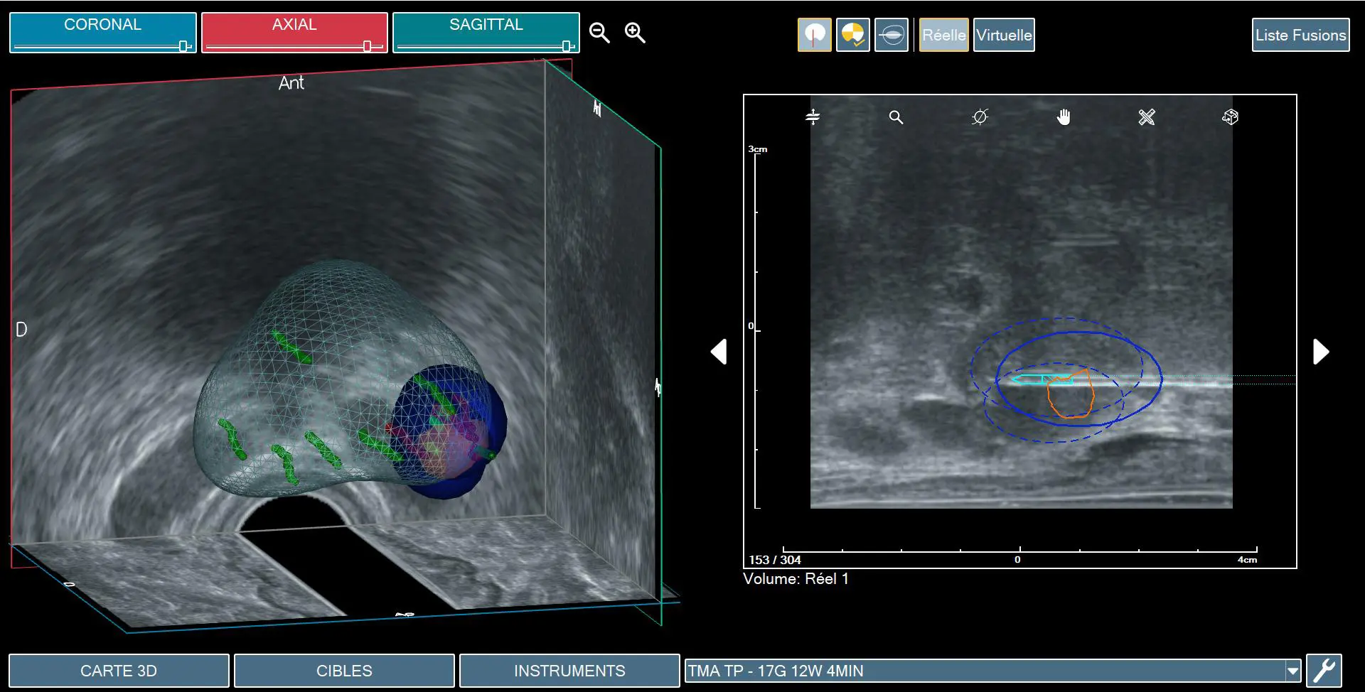 Rekonstrukcja bryły prostaty do leczenia TMA ogniska raka w lewym płacie