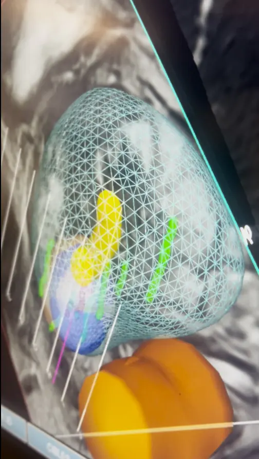 Rekonstrukcja odbytnicy i cewki moczowej dla bezpieczeństwa podczas zabiegu TMA