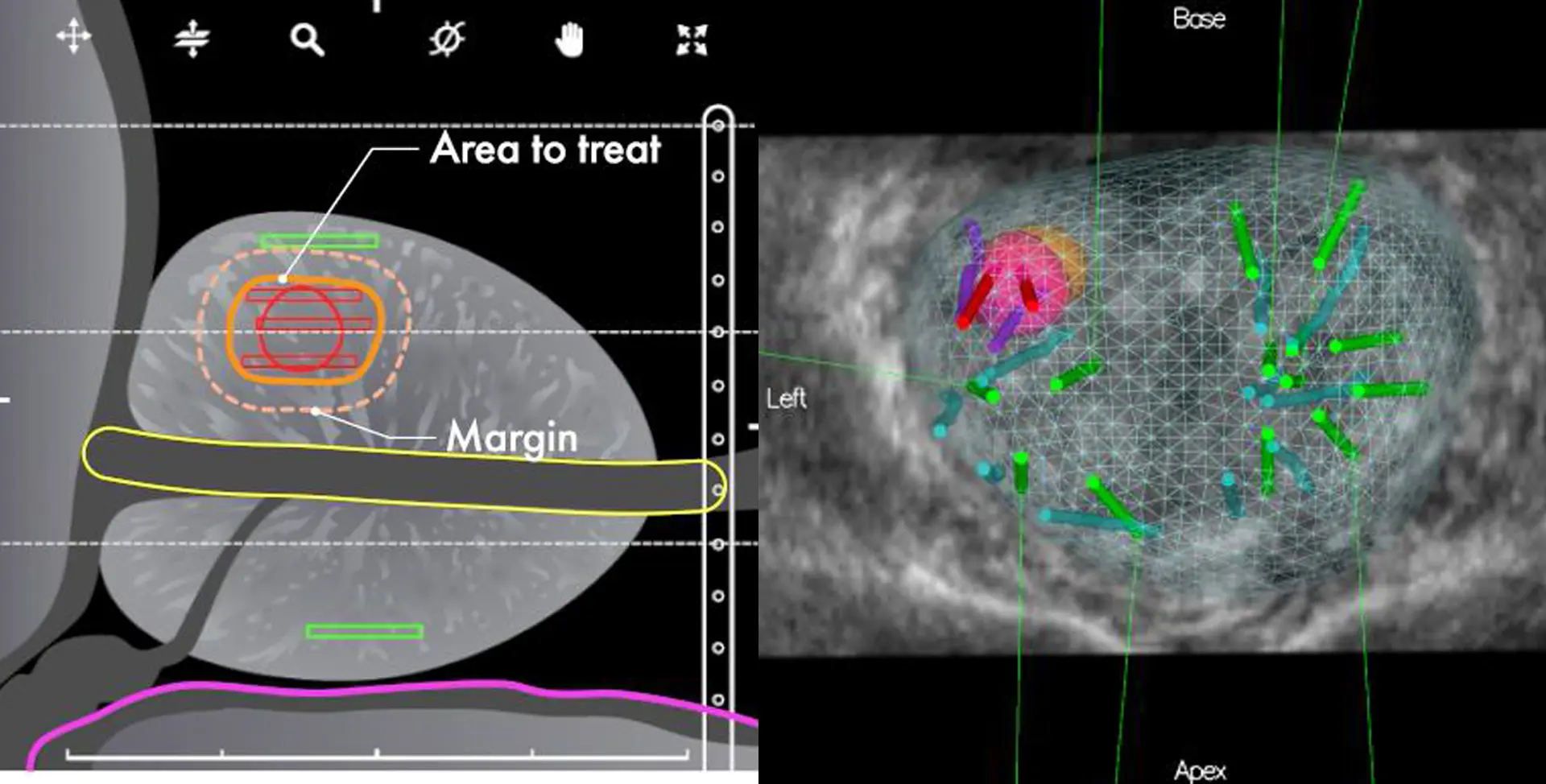 Zastosowanie marginesów leczenia TMA na tle biopsji fuzyjnej
