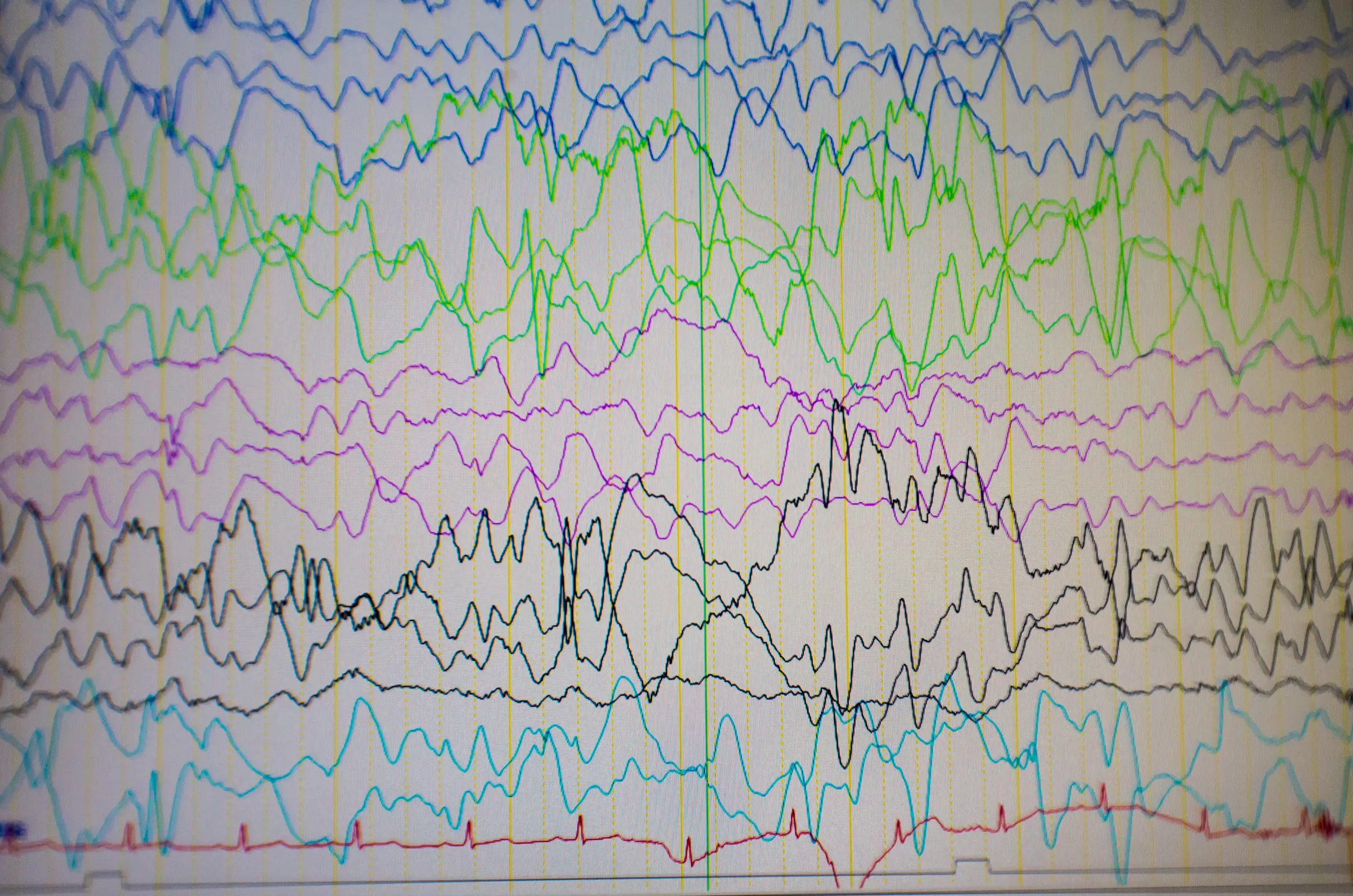 badanie-snu Badanie snu w warunkach szpitalnych w Carolina