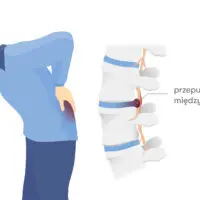 Endoskopowe operacje kręgosłupa