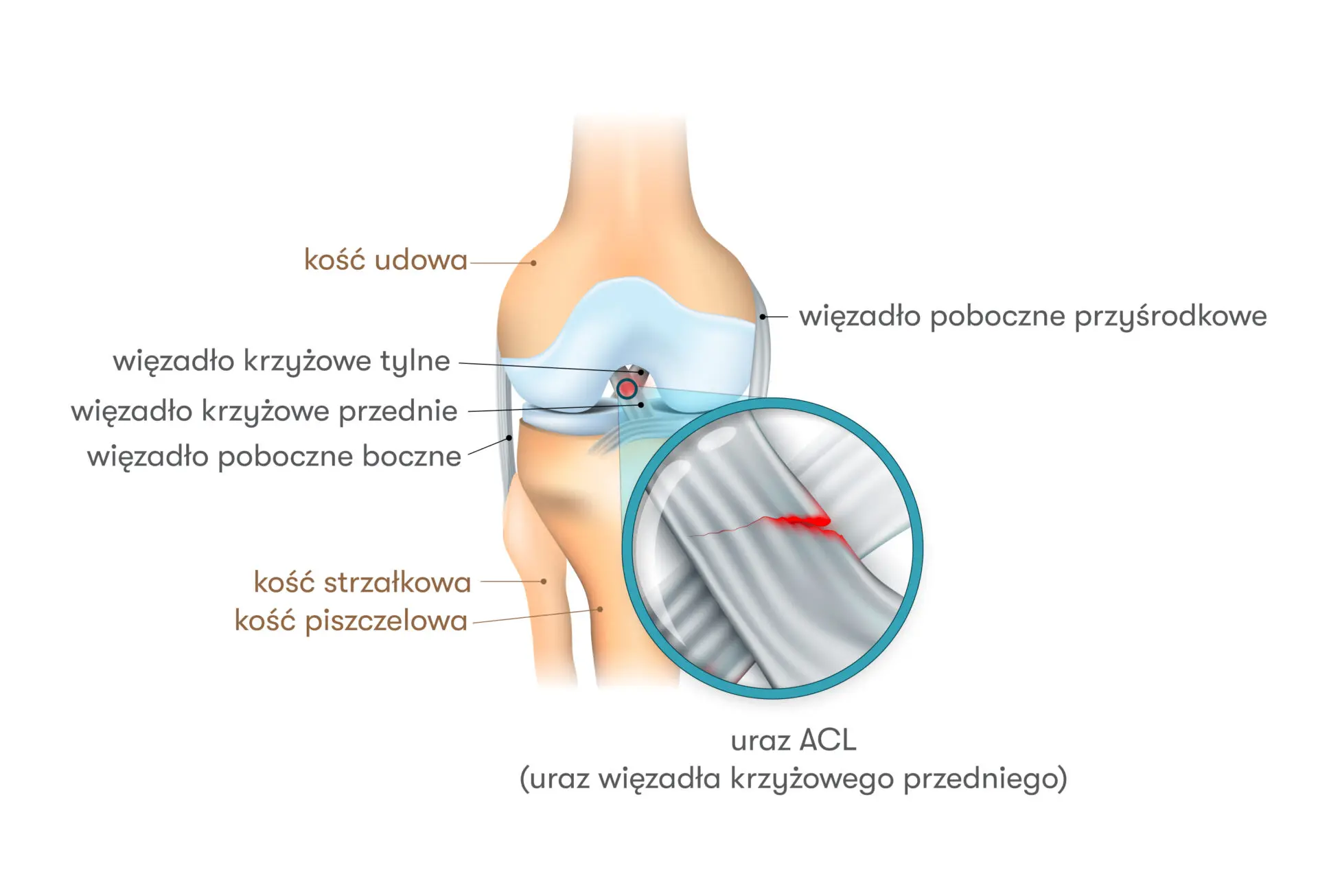 Zerwane więzadła krzyżowe – czym jest ACL?