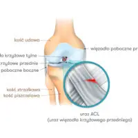 Zerwane więzadła krzyżowe – czym jest ACL?