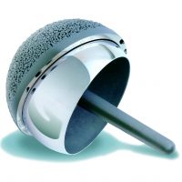 CMC_BHR_endoprotezoplastyka biodra Kapoplastyka z wykorzystaniem implantu BHR to najmniej inwazyjna z dostepnychmetod plastyki stawu biodrowego.