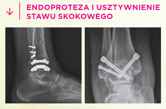 Endoprotezoplastyka stawu skokowego i artrodeza stawu skokowego