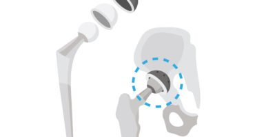 Implant dual mobility
