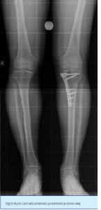 rtg_osteotomia