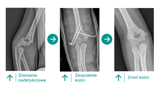 CMC_leczenie_złamanie_nadkłykciowe